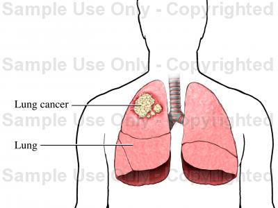 Lung Cancer Drawing At Getdrawings 