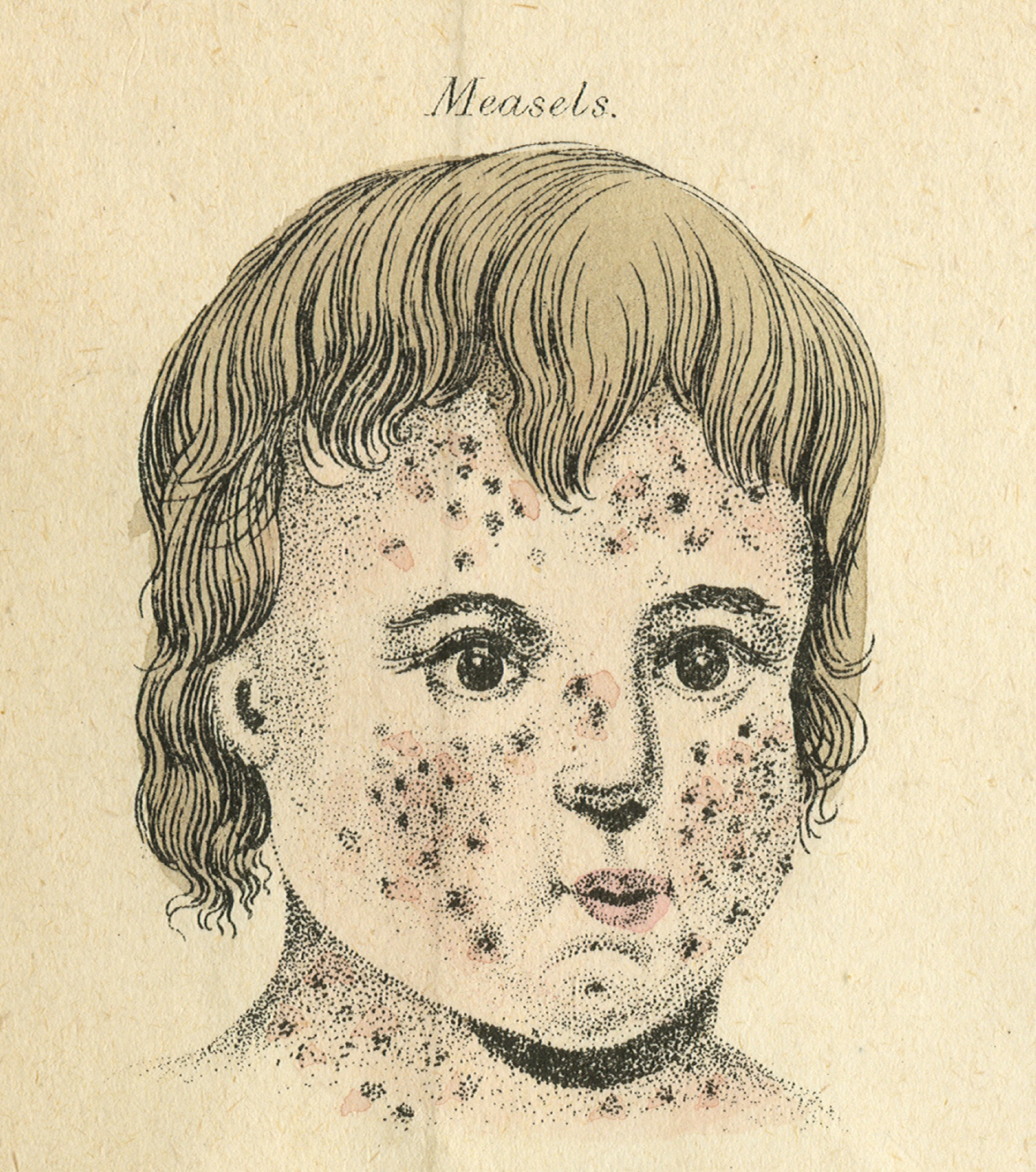 Measles Drawing at GetDrawings Free download