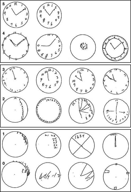 Dementia Clock Drawing at GetDrawings Free download