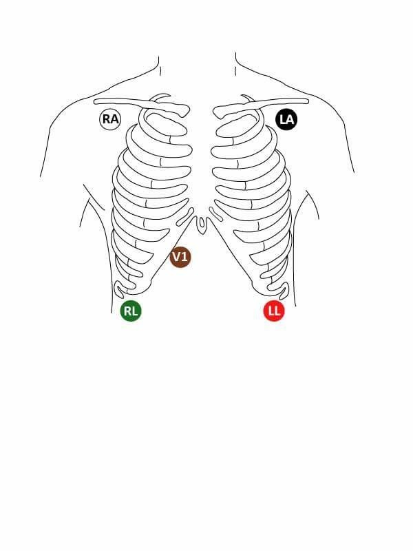 Ecg Placement Chart