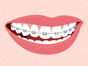 300x225 Smiles With Braces Clipart Free Images