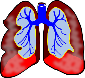300x275 Mesothelioma Clip Art