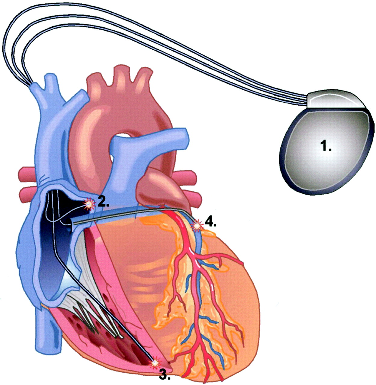 1249x1280 Cardiac Pacemaker Clipart