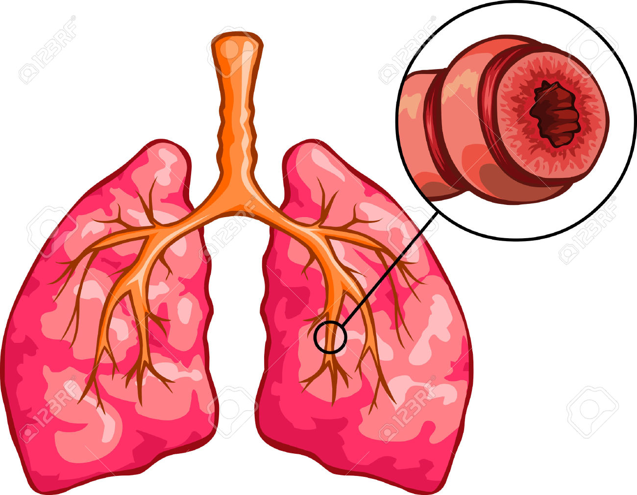 Бронхит 2024. Бронхоэктатическая астма. Лёгкие человека с бронхиальной астмой. Бронхиальная астма рисунок. Здоровые легкие и легкие астматика.