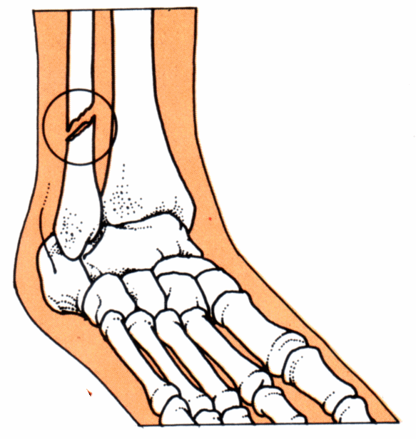 583x616 Broken Ankle Clipart Amp Broken Ankle Clip Art Images