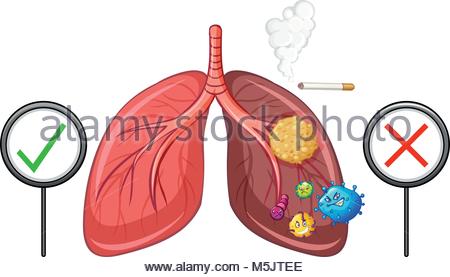 450x277 Diagram Showing Lungs With Disease Illustration Stock Vector Art