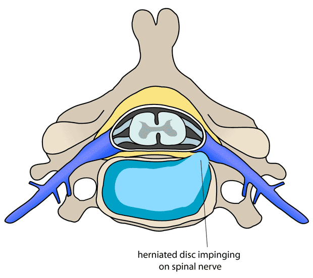 620x551 What Does Lean Tissue Removed From The Body Look Like Clipart