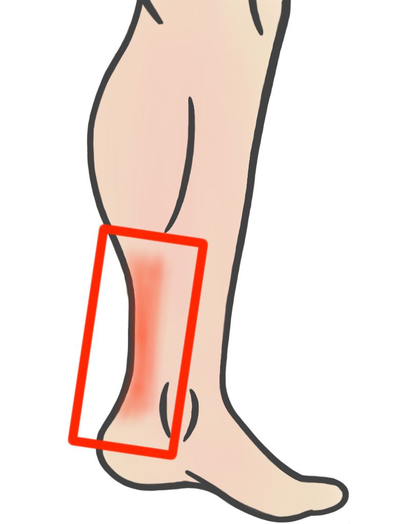 768x1024 Achilles Clipart Achilles Heel