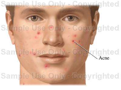 Acne Drawing at GetDrawings | Free download