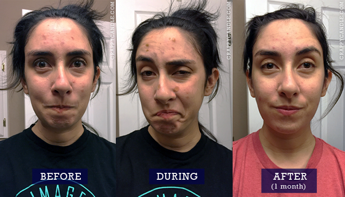 700x400 Prid Vs Nexcare Acne Patches