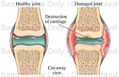 400x261 Synovial Joint Showing Arthritis