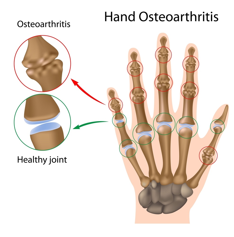 985x1000 What Is Osteoarthritis Signs, Symptoms, And Causes