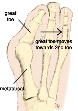 274x387 Advice On Foot Care Bunions Hallux Valgus