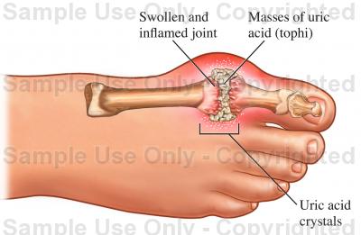 400x261 Gout Of The Big Toe