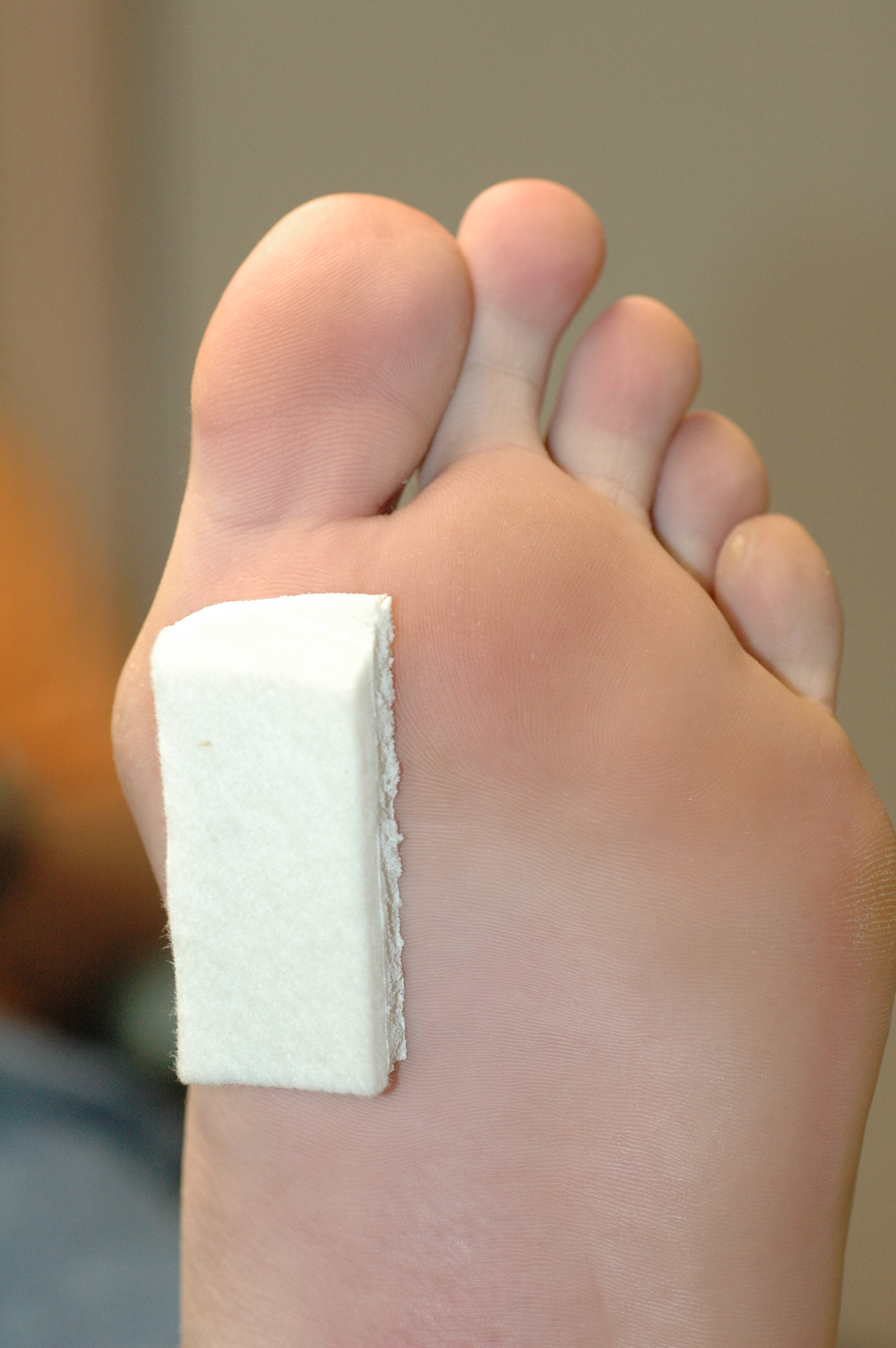 2000x3008 Morton's Toe What Is It, What Causes It, How To Treat It