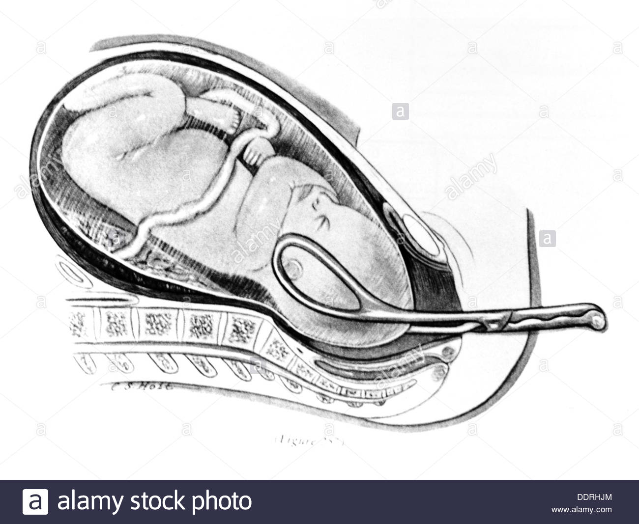 1300x1067 Medicine Birth Gynecology Retrieval Of The Baby With Forceps