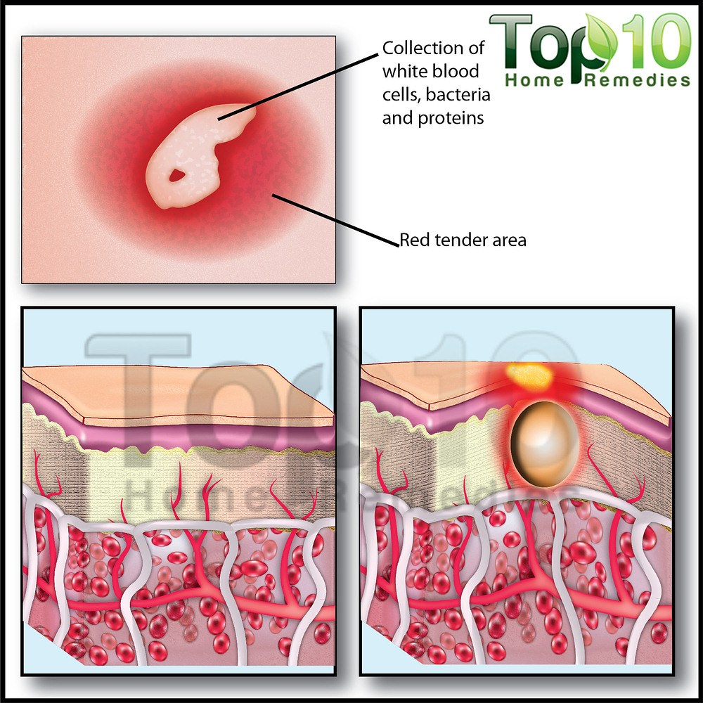 1000x1000 Home Remedies For Boils And Abscesses Top 10 Home Remedies