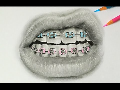 480x360 Drawing Realistic Braces