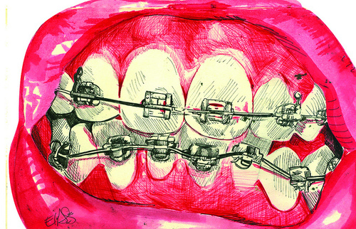 500x322 Art, Braces, Drawing, Lovely, Pink