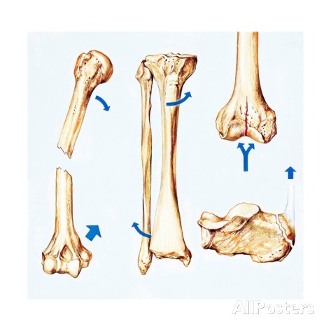 473x473 Musculoskeletal Locomotor System Indirect Fractures Of The Bones