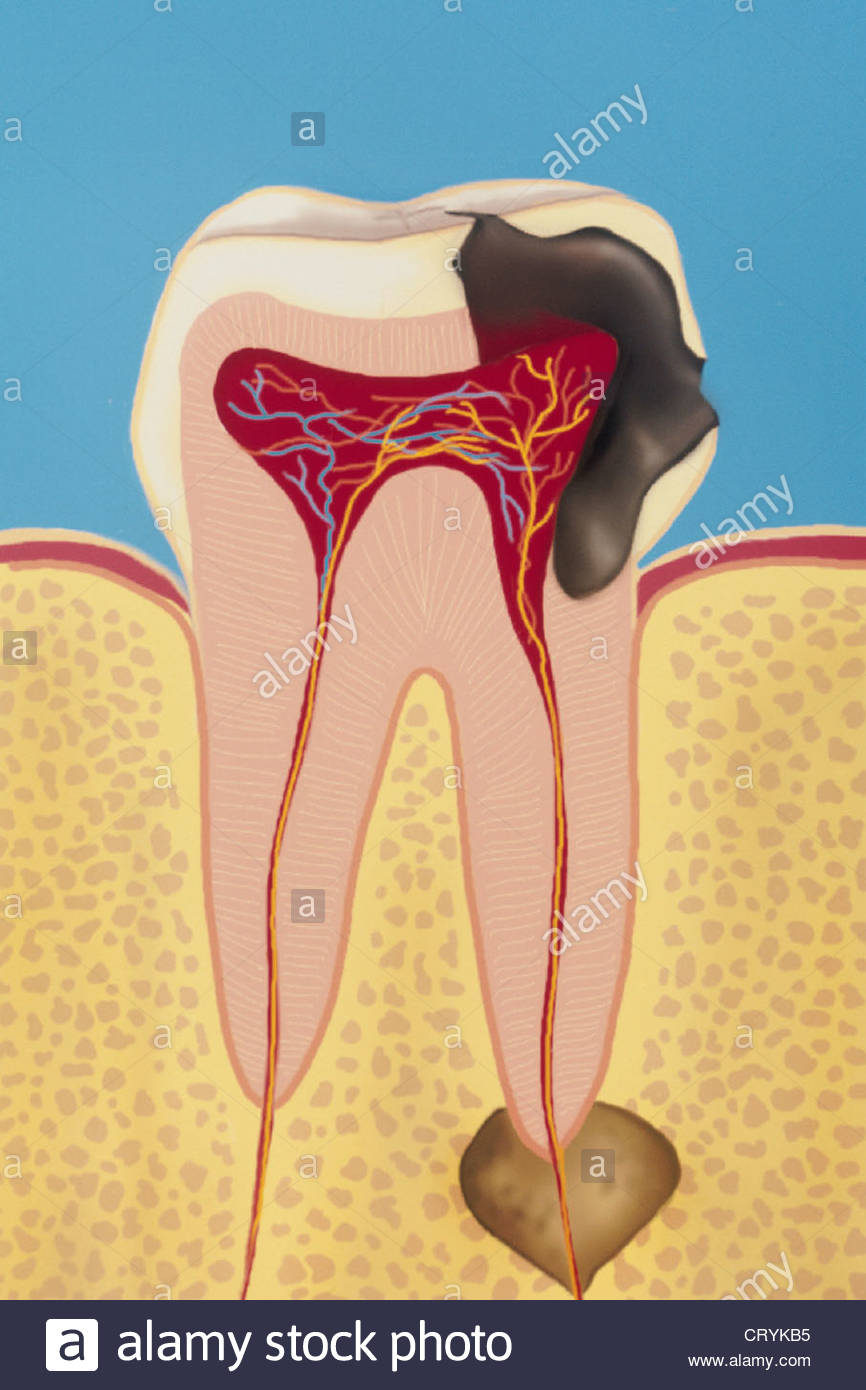 866x1390 Dental Abscess, Drawing Stock Photo 49165737