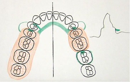 450x283 Dentalaka Clinical Stages In Removable Partial Denture Construction