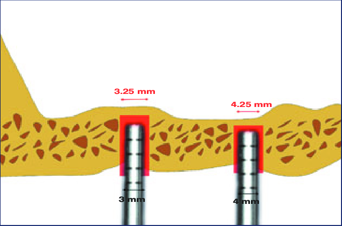 680x450 Schematic Drawing Of Friction Free Osteotome Technique.