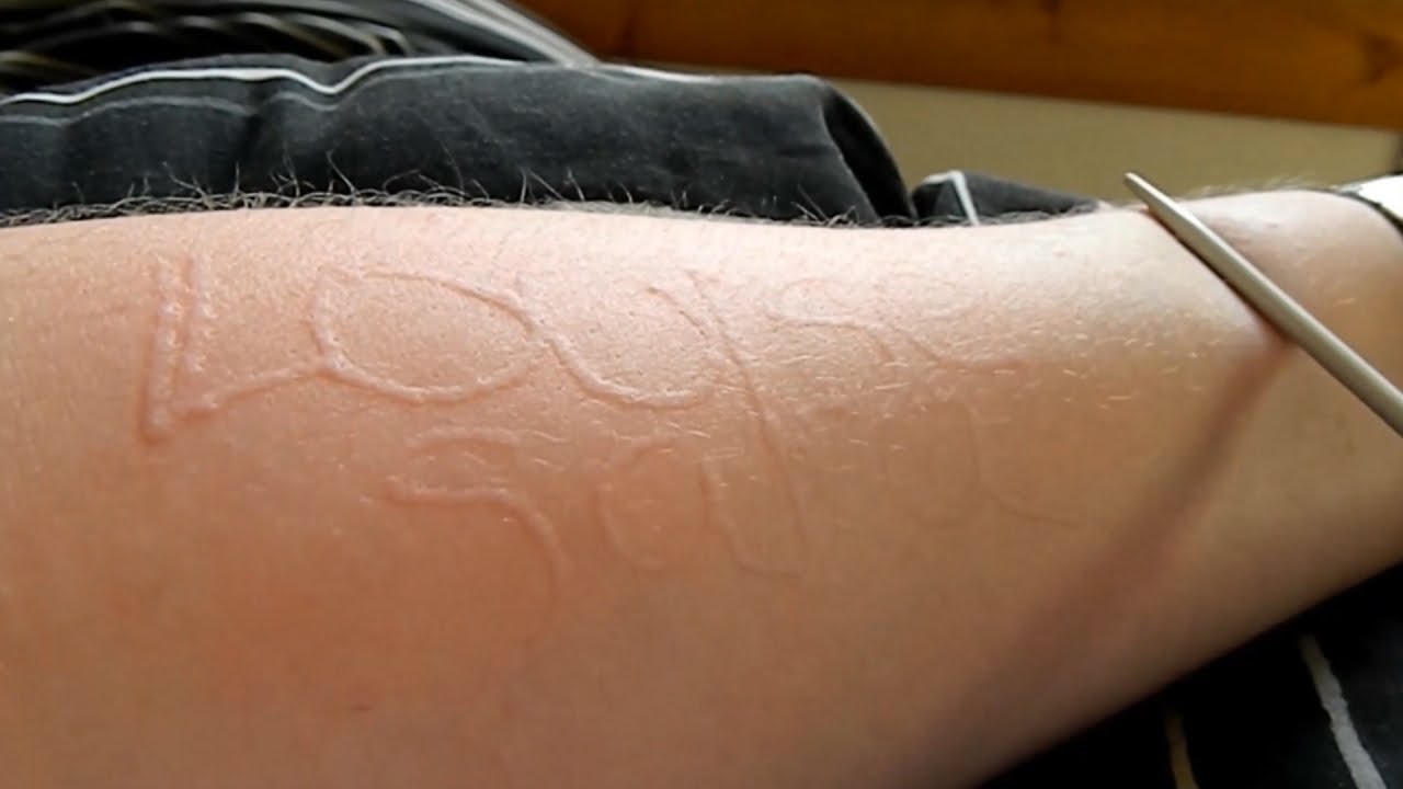 1280x720 Rare Condition Allows Woman To Draw On Her Skin Without Ink