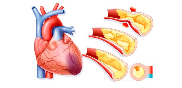 615x297 Heart Disease Risk Revealed Decades Before Symptoms Begin In New