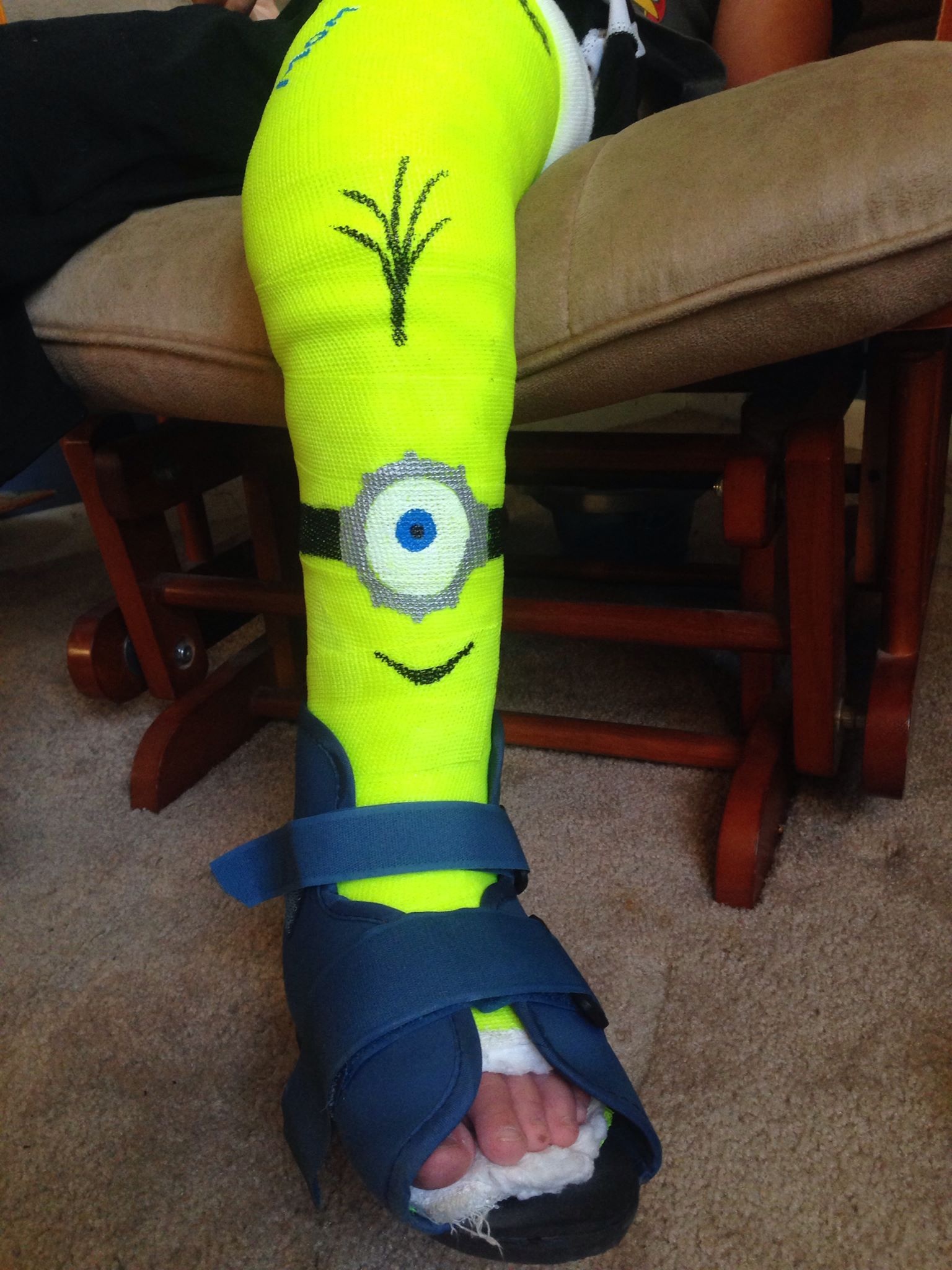 1536x2048 Our Kindergartener Had To Start School In A Full Leg Cast, So My