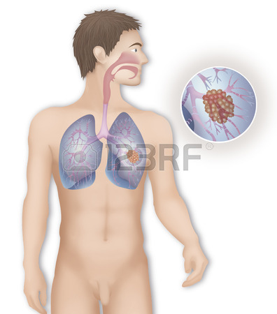 396x450 Lung Cancer,drawing Stock Photo, Picture And Royalty Free Image