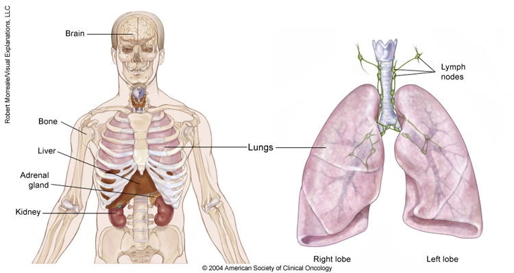 750x399 Lung Cancer