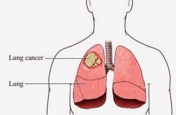 350x230 Signs That Thyroid Cancer Has Spread