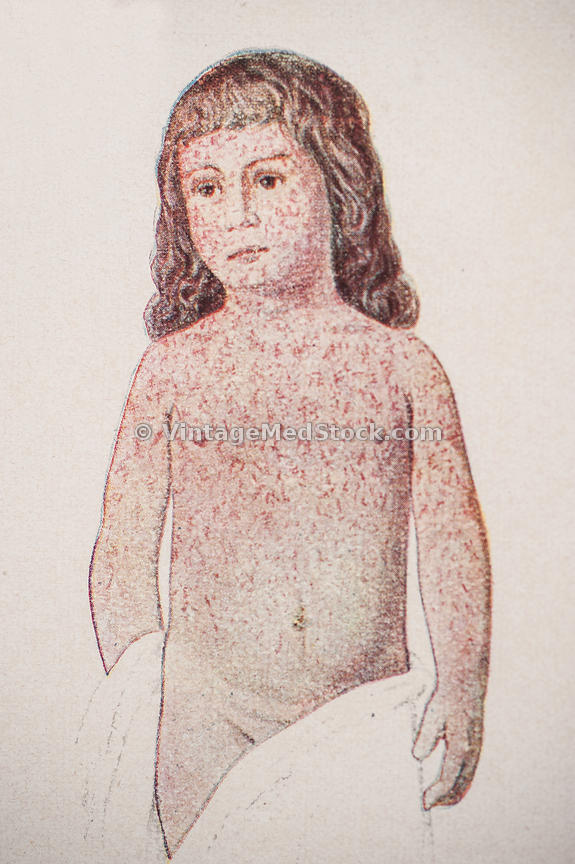 575x864 Vintagemedstock Measles