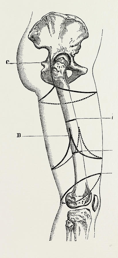 411x900 Circular Amputation Of Thigh, Medical Equipment Drawing By Litz