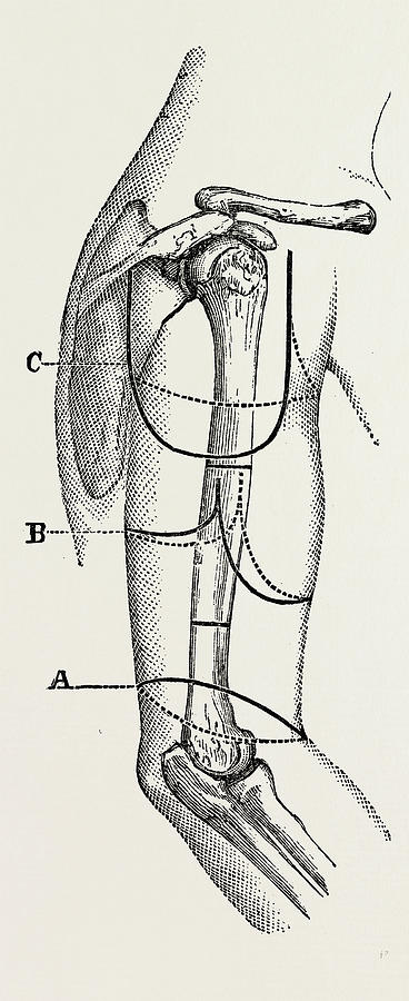 368x900 Circular Inclined Amputation, Medical Equipment Drawing By Litz