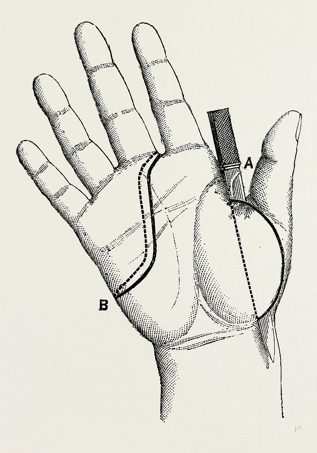 629x900 Disartieulation Of The Thumb, Medical Equipment Drawing By Litz