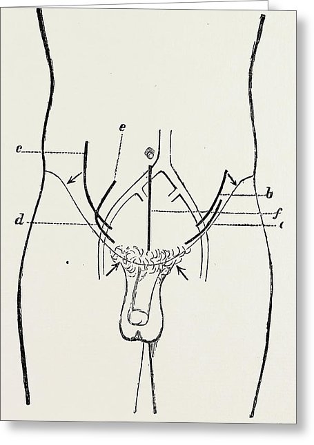 455x646 Ligature Of External Iliac, Medical Equipment Drawing By Litz