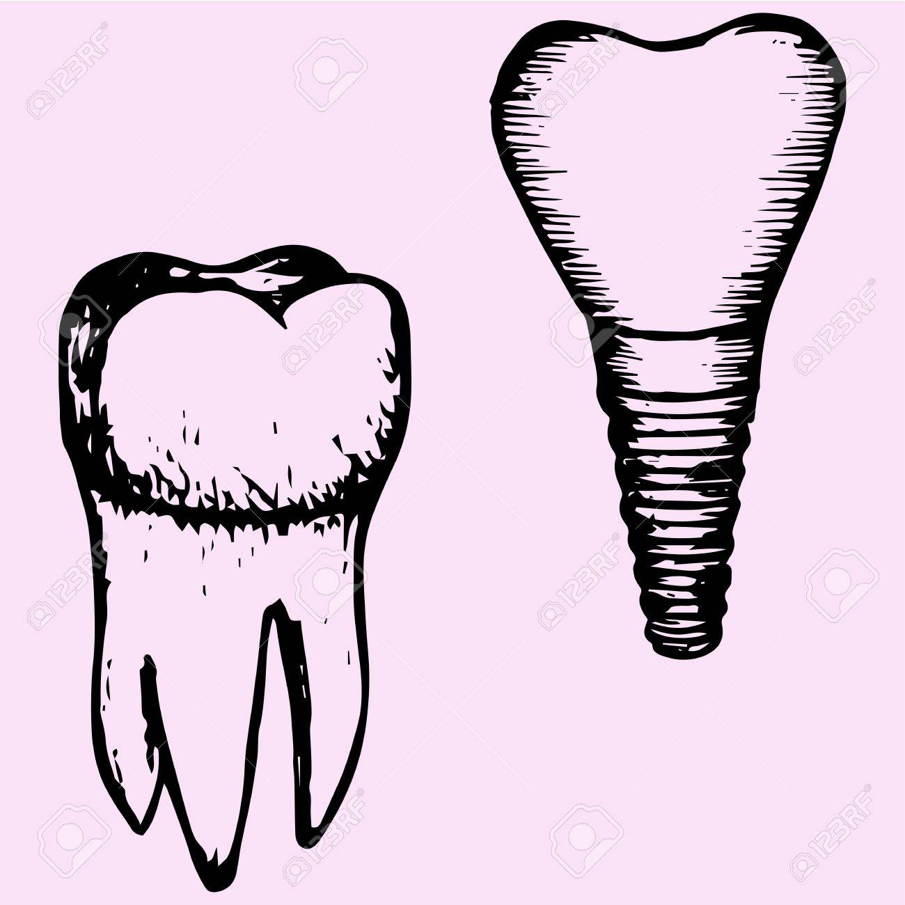 1300x1300 Set Tooth Implant And Molar, Doodle Style Sketch Illustration