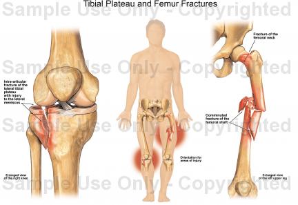 432x297 Tibial Plateau And Femur Fractures