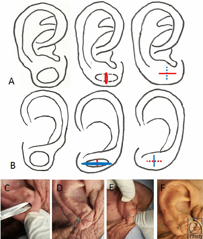 790x927 A ) Drawing Of Repair Method, Anterior Aspect Of Ear. ( B