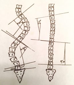 259x300 Scoliosis X Ray Analysis Chiropractic's Non Surgical Treatment