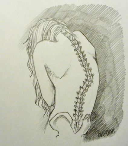 424x485 Scoliosis By Semla On @ Scoliosis