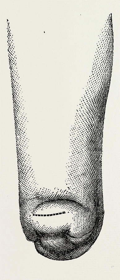 388x900 Stump, Medical Equipment, Surgical Instrument Drawing By Litz