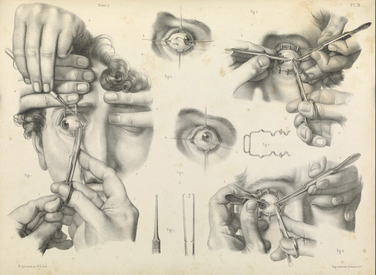 745x544 19th Century Surgical Illustrations Eerily Captivating