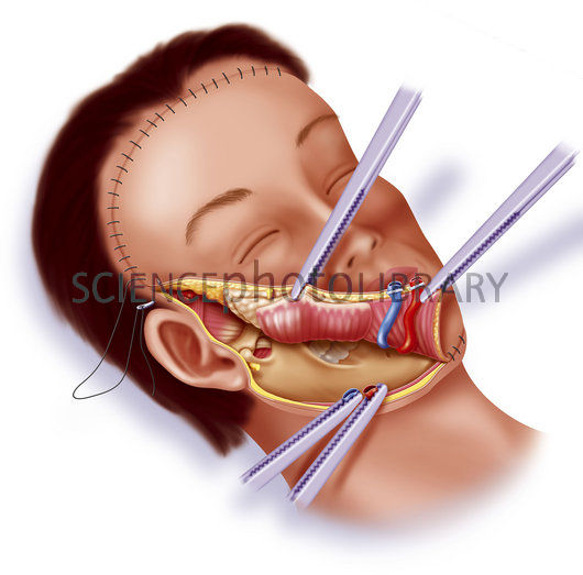 530x523 Plastic Surgery, Drawing