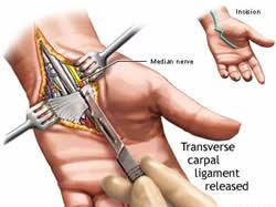 250x187 Carpal Tunnel Syndrome Surgery Drawing Used To Take Sutures Out