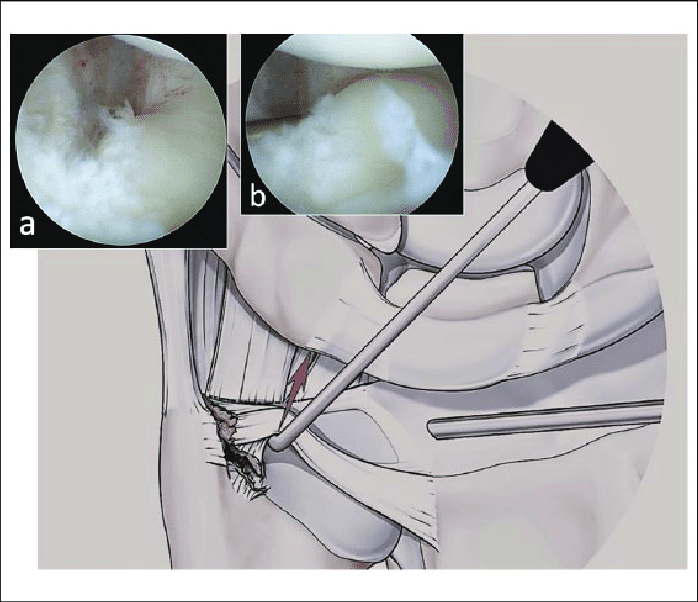 698x602 Drawing Showing A Foveal Avulsion Associated With A Peripheral