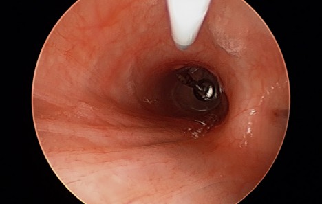 468x297 Thumbtack In Bronchus Be Smart, Don'T Choke
