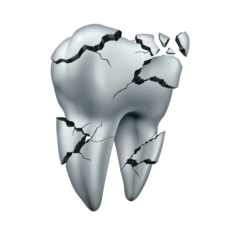 800x795 Tooth Dental Fracture Drawing